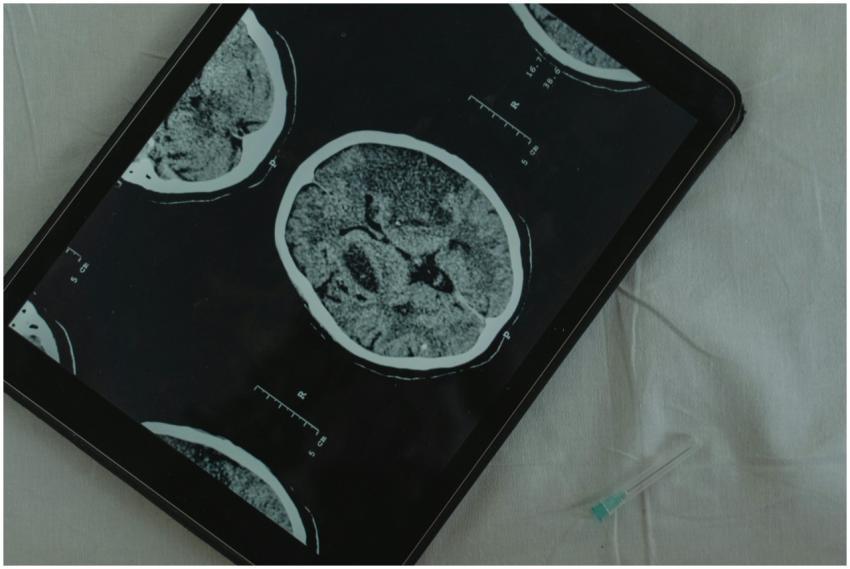 Close-up view of a brain CT scan displayed on a di