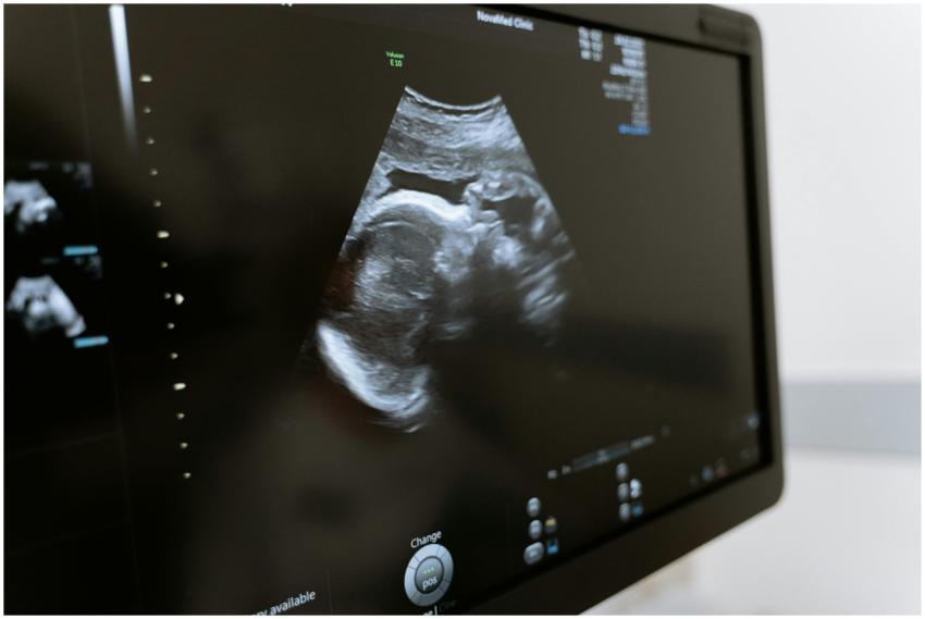 Close-up of an ultrasound showing a fetus on a mon