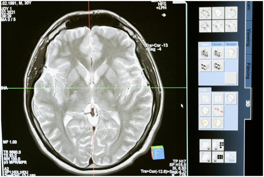 Intricate MRI brain scan displayed on a computer s