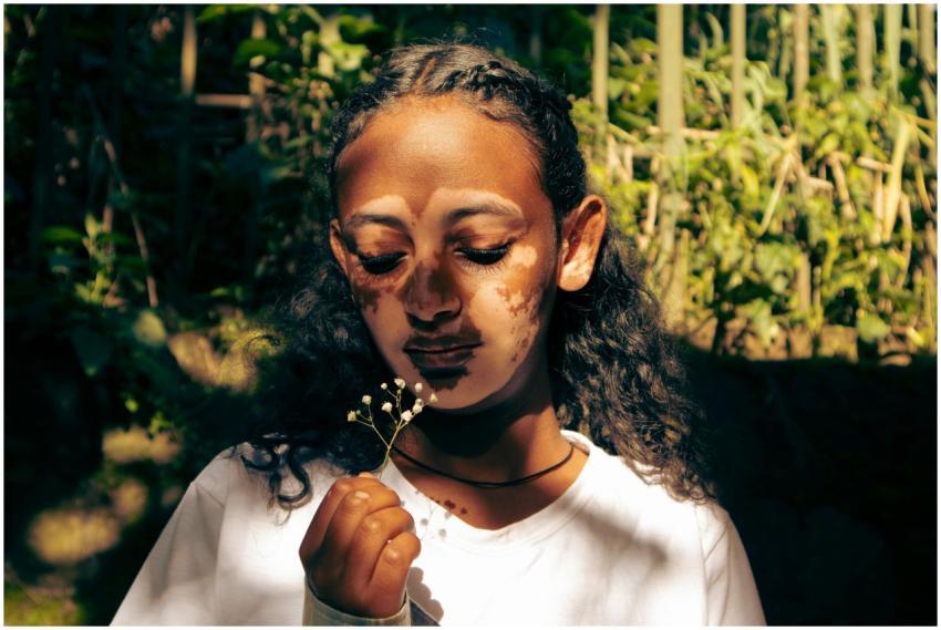 A young Ethiopian woman with vitiligo holds a smal