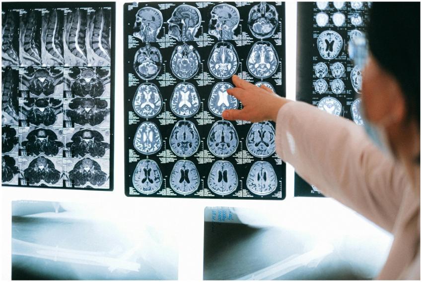 Radiologist pointing at brain MRI scans showing de