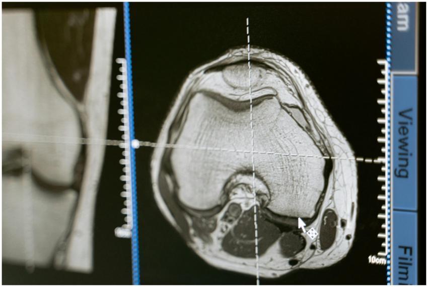 Close-up of an MRI scan displayed on a medical mon