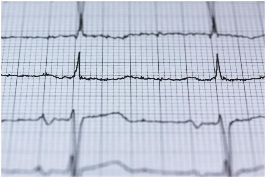Close-up view of an ECG reading on graph paper, di