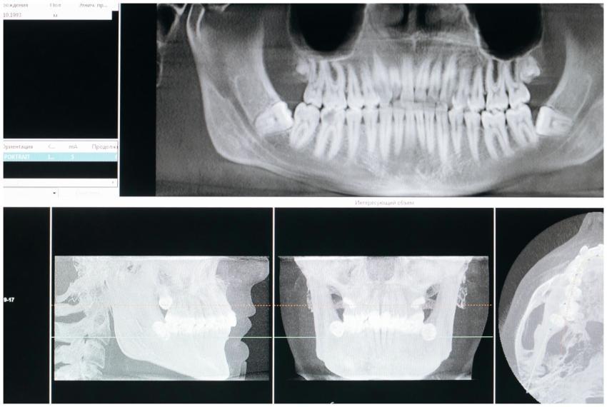 Detail image of a panoramic dental X-ray, showing
