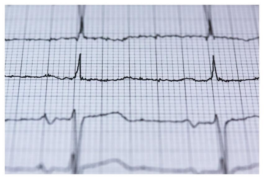 Ecg Electrocardiogram Medicine Heartbeat