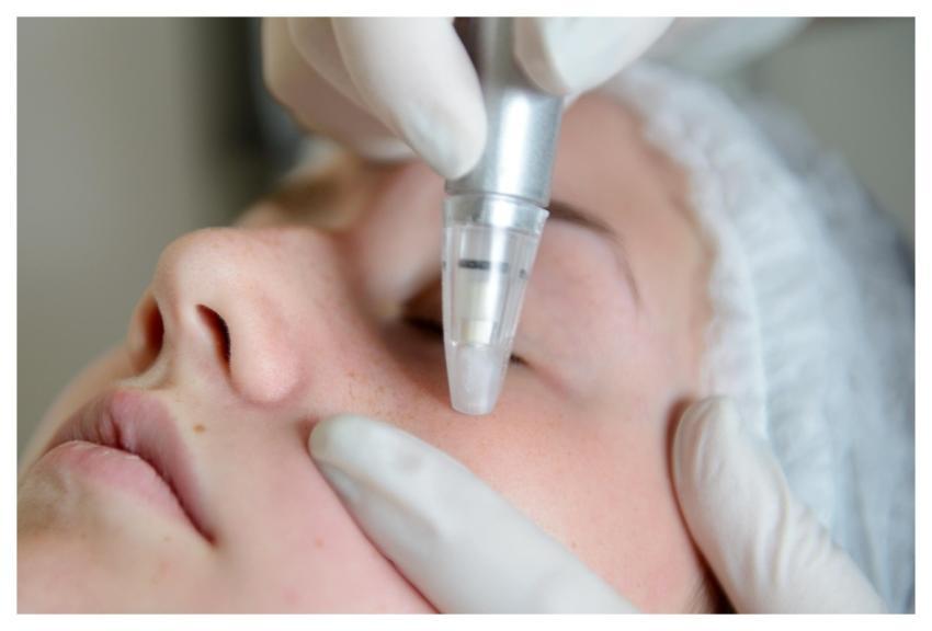 Woman Microdermabrasion Skin Improvement People