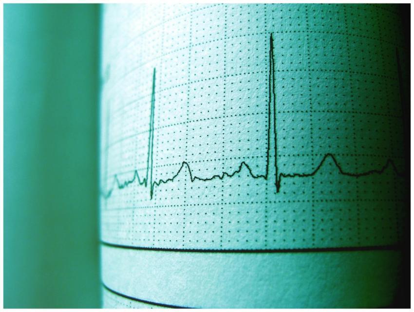 Close-up of an ECG printout displaying heartbeat r