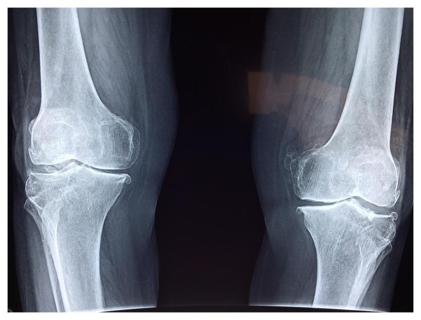 Knee X-Ray Medical Anatomy
