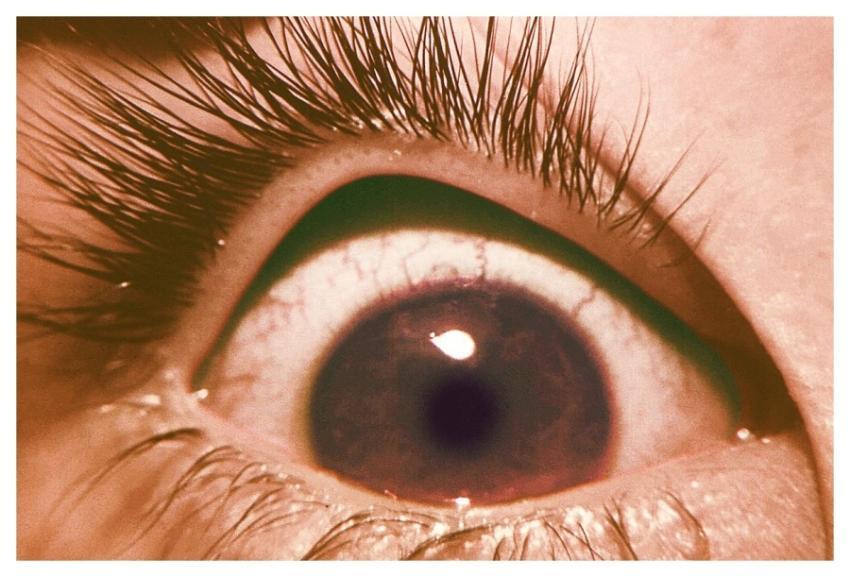 The normal right eye of a boy whose left eye was i