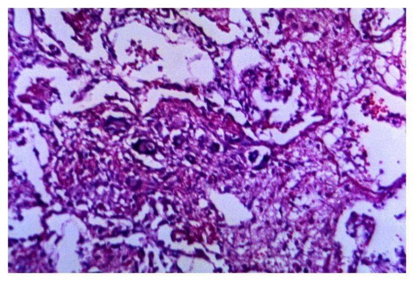 A 125X photomicrograph magnification of a hematoxy
