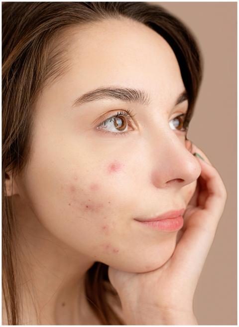 Close-up portrait of a young woman with acne, hand