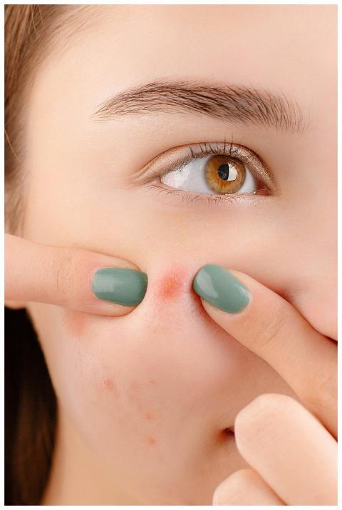 A young woman squeezing a pimple on her face, show