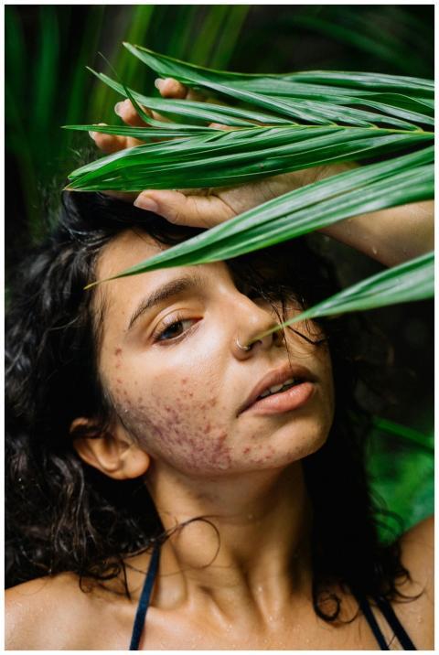 Close-up of a woman with acne and nose piercing su