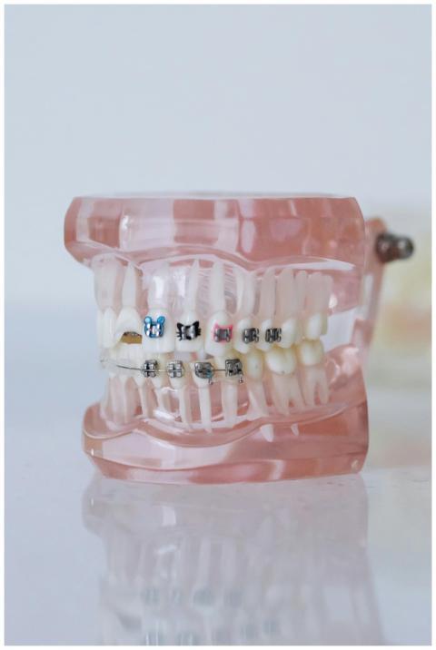 Close-up of a dental model showcasing braces in a