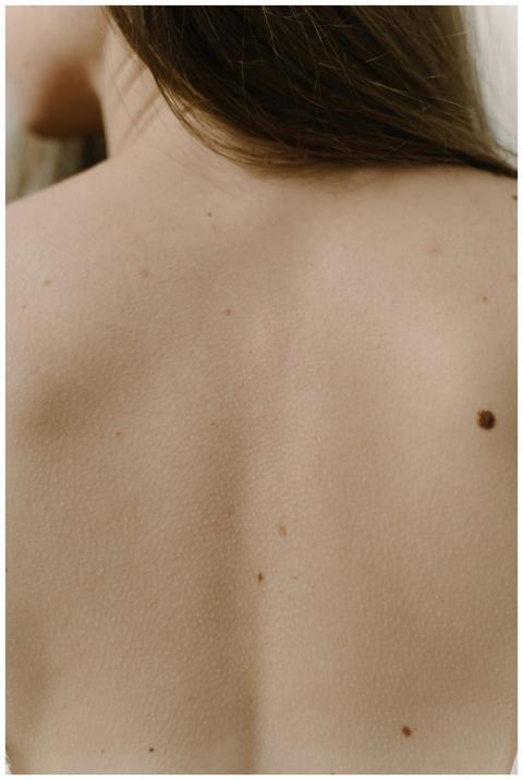 Detailed view of a woman's back with moles, emphas