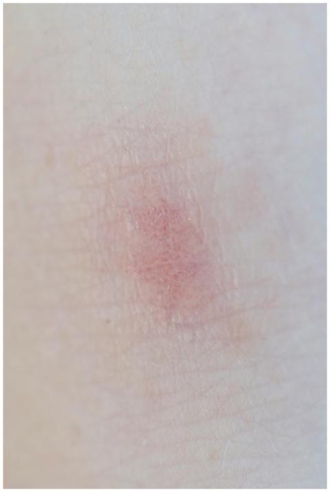 Detailed view of a red skin rash or irritation on