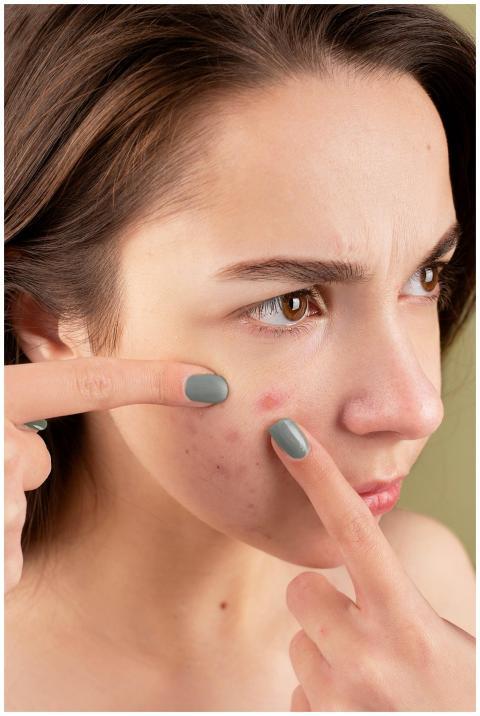 Close-up of a young woman treating her acne-prone