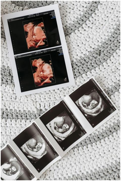 Close-up ultrasound images showing prenatal develo