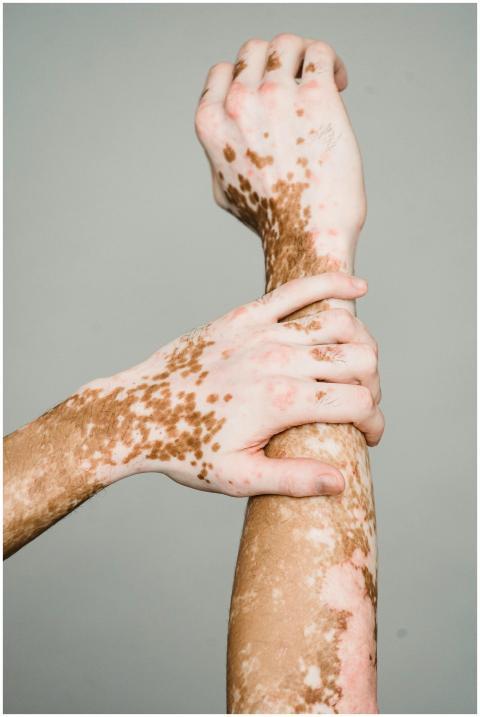 Detailed view of hands showing skin condition, hig