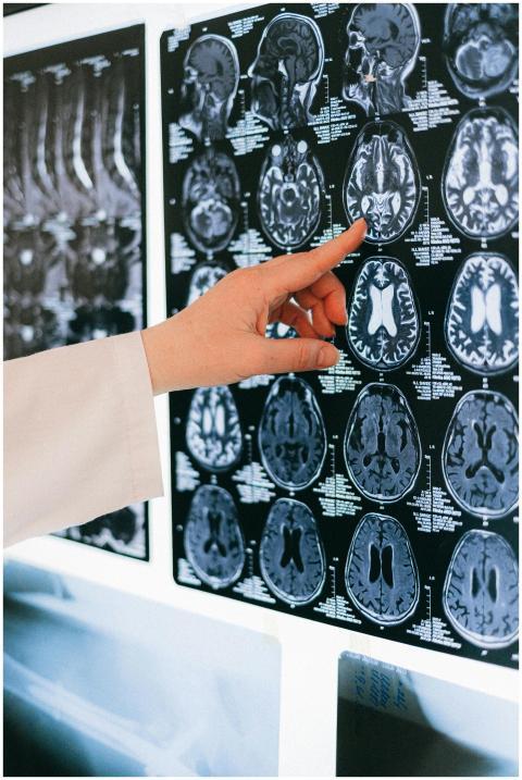 A doctor's hand points to a brain MRI scan on a li