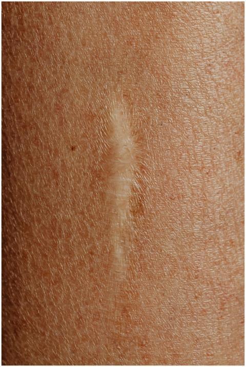 Detailed close-up image of a skin scar, highlighti