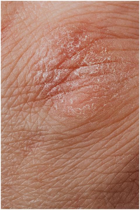 Detailed image highlighting dry, flaky skin textur