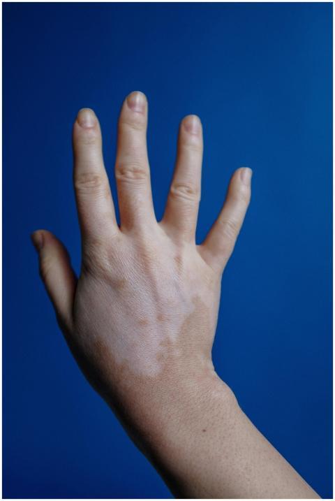 Close-up of a hand with vitiligo, fingers spread,