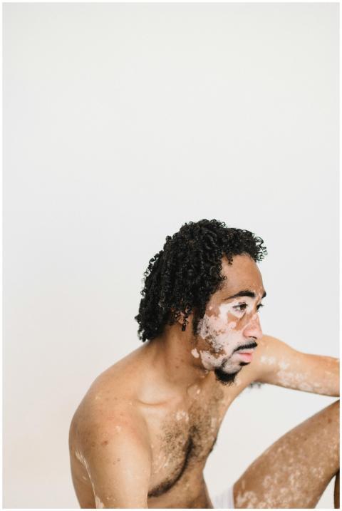 Side view of a thoughtful man with a skin conditio