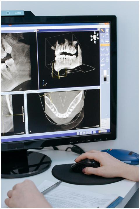 Close-up of dental X-ray images displayed on a com