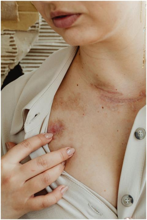 A detailed close-up of a woman's chest showing sca