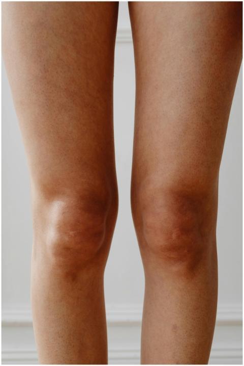 Detailed close-up of human knees, emphasizing skin