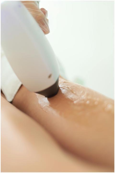 Close-up of a laser hair removal procedure on smoo